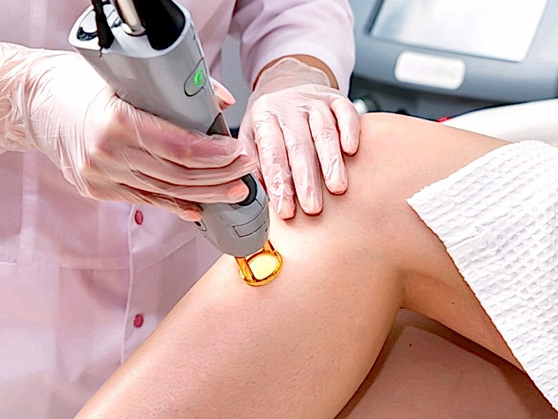 Lazer Epilasyonu Nedir